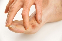 Bunions May Develop for Several Reasons
