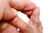How Can You Tell If Athlete’s Foot Has Developed